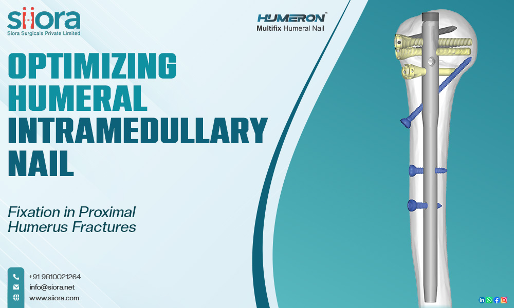 Optimizing Humeral Intramedullary Nail Fixation in Proximal Humerus&nbsp;Fractures